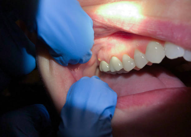 Best Emergency Tooth Extraction in Whitewright, TX